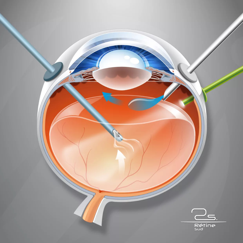 Décollement de la rétine : Urgence, prévention et traitement
