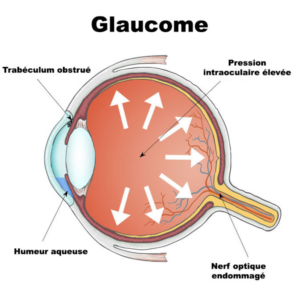 Le Glaucome : Comprendre, Prévenir et Traiter Cette Maladie Oculaire Silencieuse