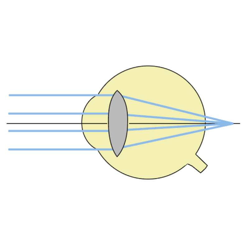 Qu'est-ce que l'hypermétropie : Comprendre et corriger ce trouble de la vision