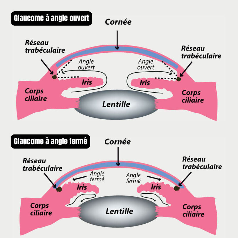 Qu'est-ce qu'un glaucome ? Comprendre cette maladie oculaire silencieuse